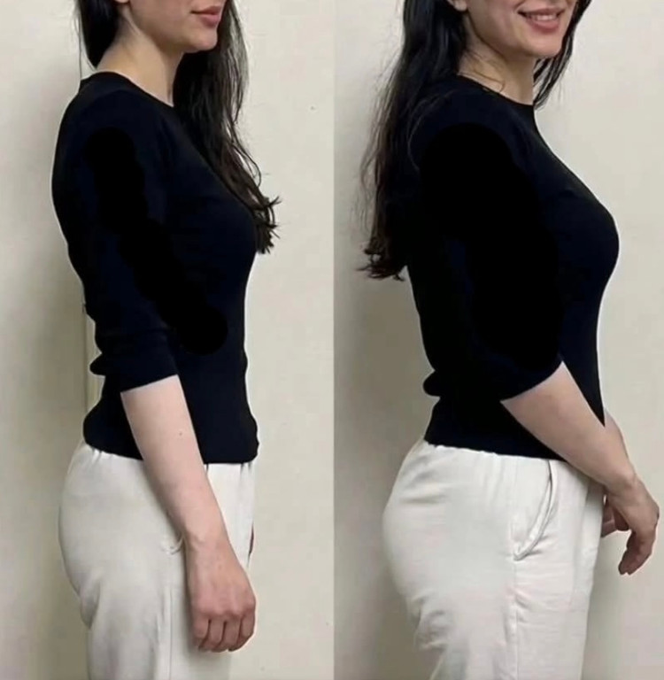 افزایش حجم سینه و باسن